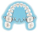 15-off-NEW-Henry-Schein-Orthodontics-Niti-Palatal-expander Sale