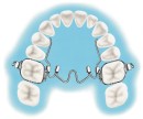 Henry-Schein-Niti-Palatal-Expander Sale
