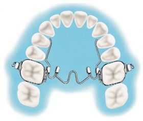 15-off-NEW-Henry-Schein-Orthodontics-Niti-Palatal-expander on sale