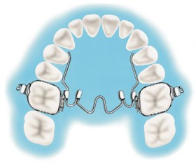 Henry+Schein+Niti+Palatal+Expander